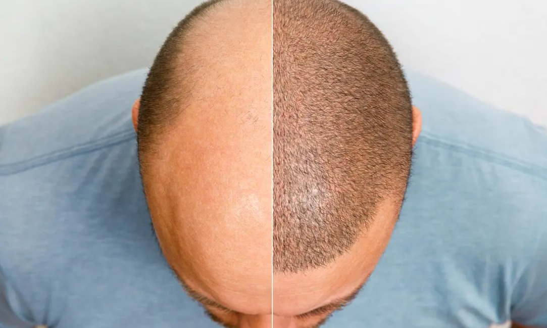 Turismo capilar: preços baixos atraem pacientes, mas riscos à saúde aumentam