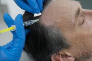 Fiz um implante capilar e agora? Especialista explica os cuidados que ajudam na recuperação e no crescimento dos fios