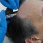 man-getting-hair-loss-treatment (1)