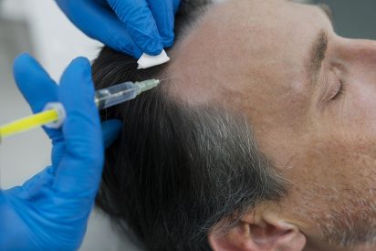 man-getting-hair-loss-treatment (1)